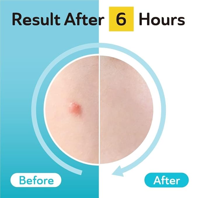 Dark Spot Patches Blemish Patches with Hydrocolloid, TXA & CICA for Active Acne & Post-Inflammatory Dark Spots - Day and Night Use - UPGRADED (Post Acne - 132 Count - 2 Size)